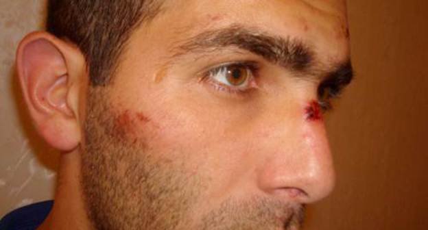 Malik Appaev with traces of beatings on his face, after release from the Elbrus ROVD (District Interior Division). Photo from the website of the Human Rights Centre "Memorial" (www.memo.ru)