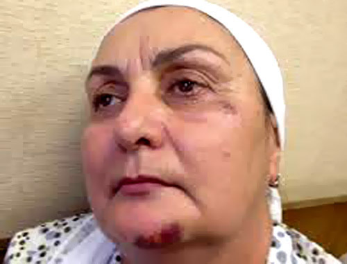 Madina Magomadova after attack in Moscow. Photo by http://www.doshdu.ru/