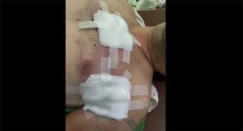 Wounds on the body of a resident of Nagorno-Karabakh. Screenshot https://www.facebook.com/photo/?fbid=4222967537832628&amp;set=pcb.4223005807828801